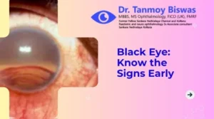 Black Eye: Know the Signs Early